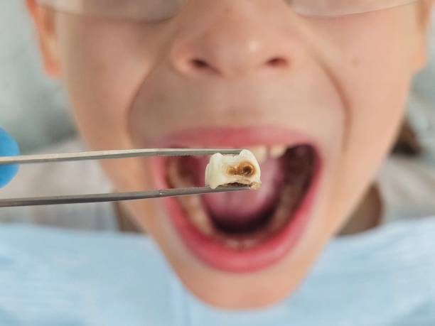 Best Emergency Tooth Extraction in North Riverside, IL